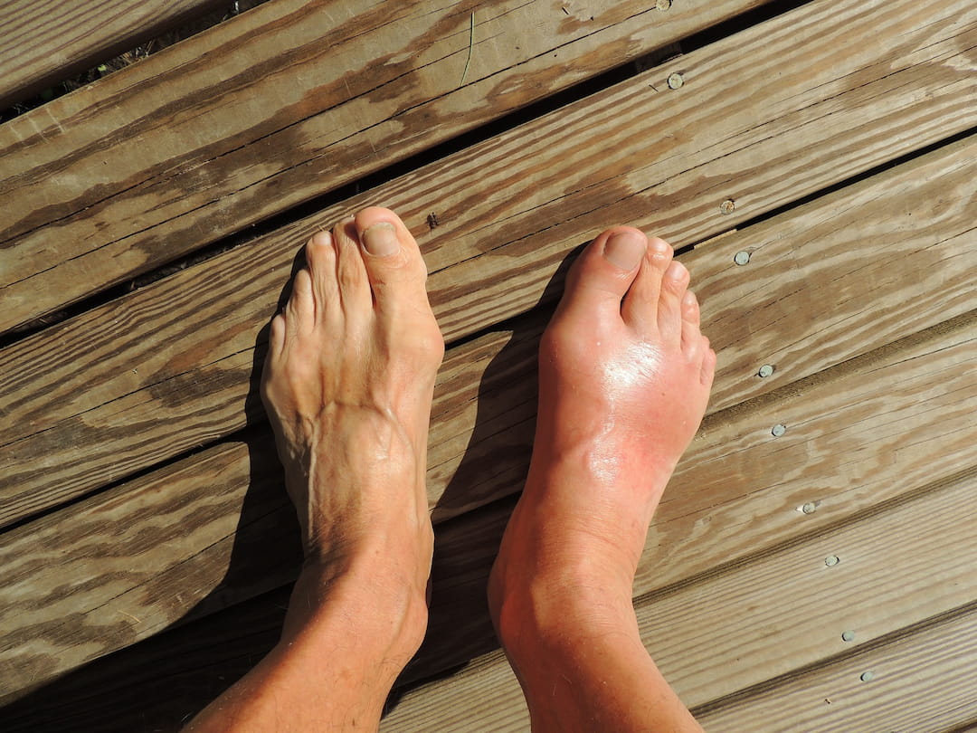 A swollen foot next to a healthy foot.