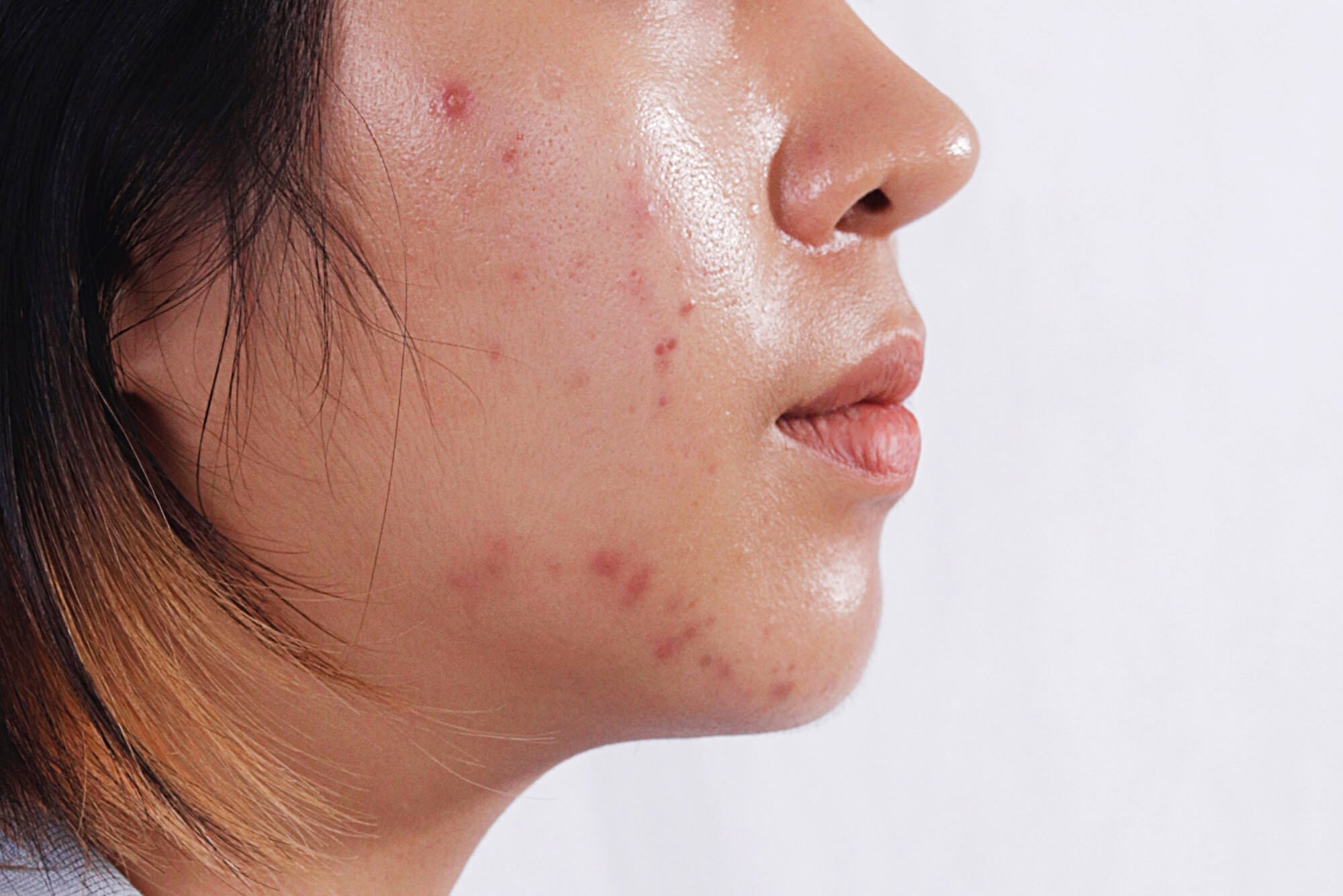how to treat acne with oily skin