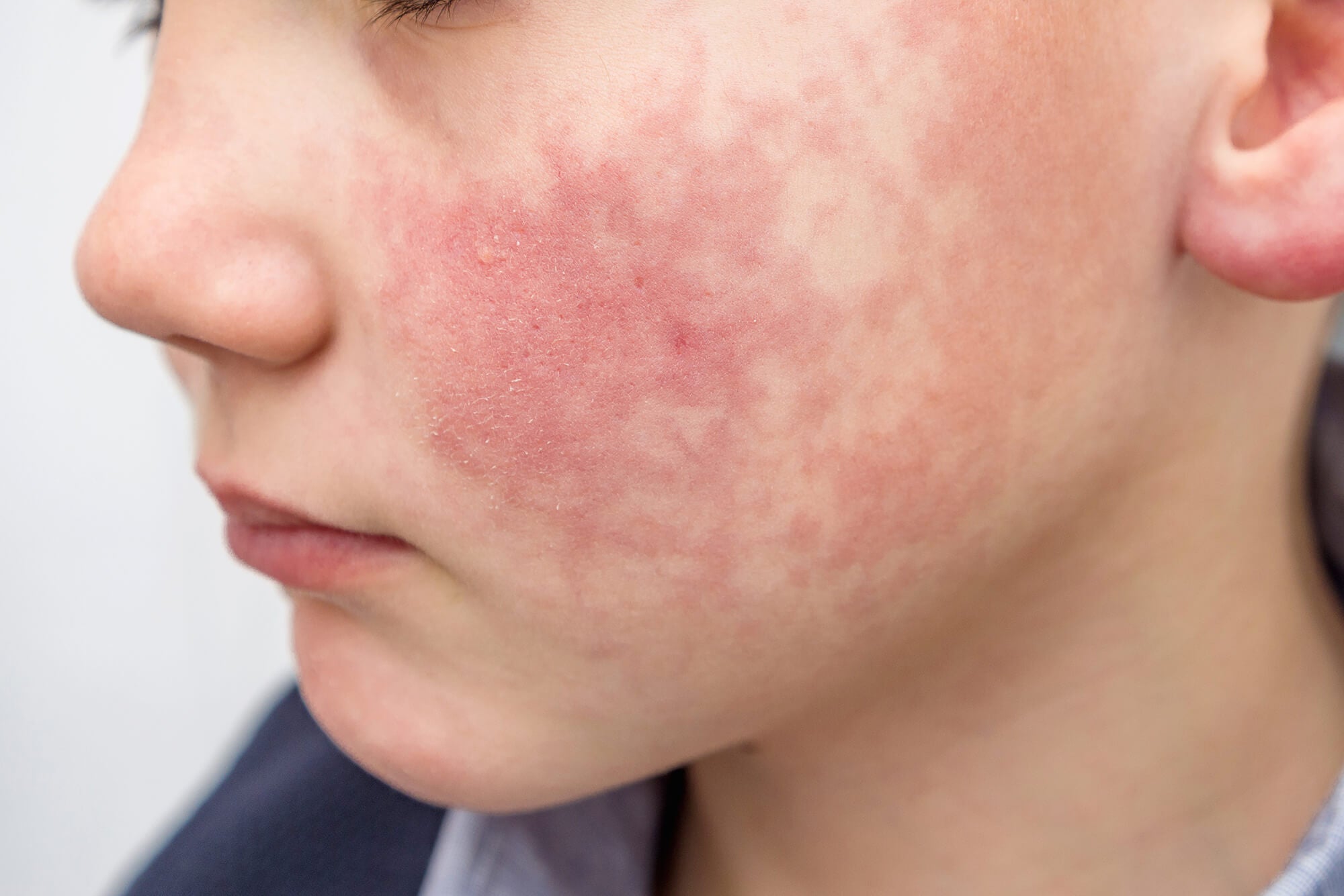 most common food allergies that cause acne