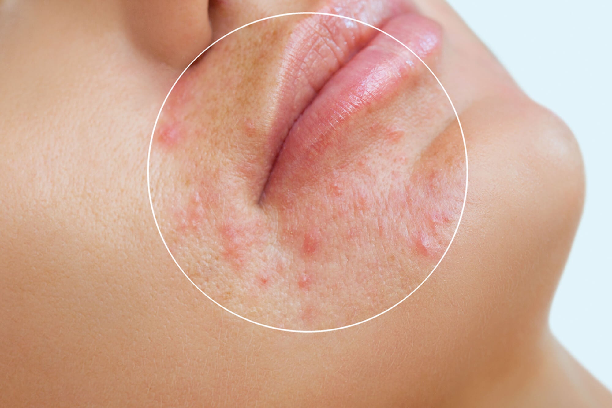 types and causes of acne and pimples
