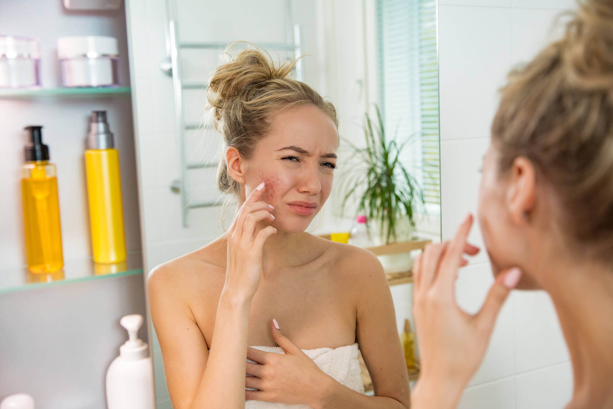 how emotional stress causes acne