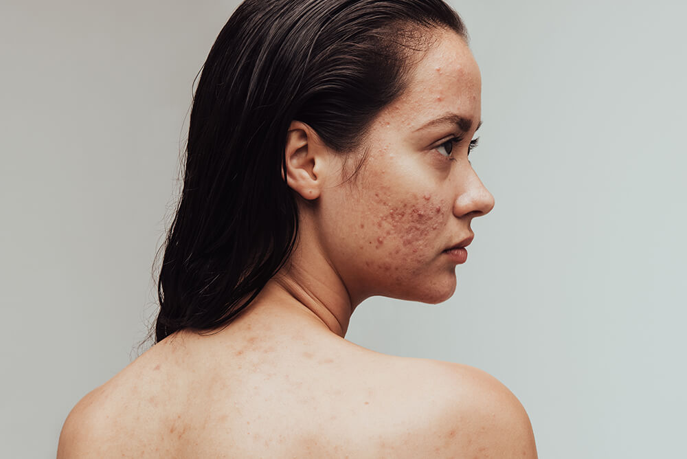 how to use tea tree oil for acne scars