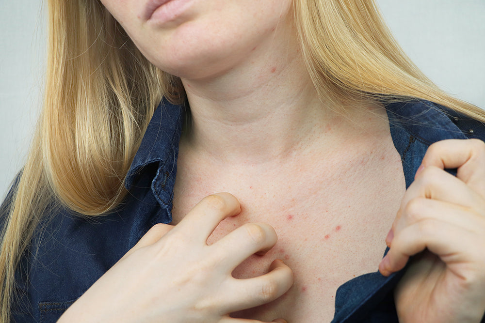 Blackheads on Breasts - Tips and Tricks to Get Rid of Blackheads on Your  Chest - Healthwire