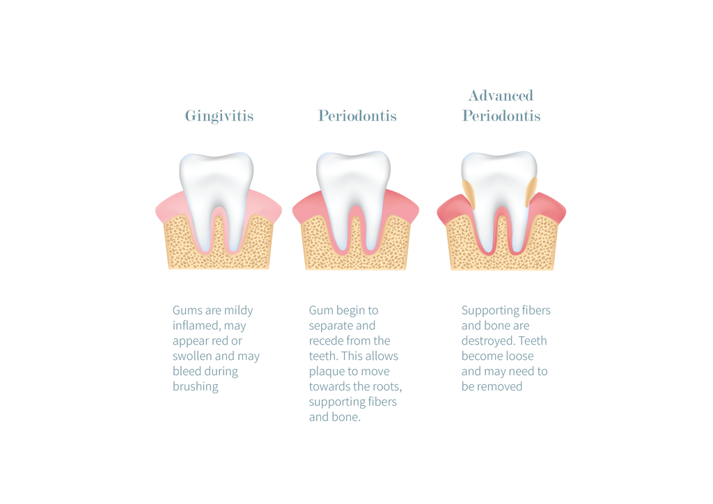 The Ultimate Guide to Maintaining Healthy Gums: Tips for a Strong Smile Three stages of unhealthy gum