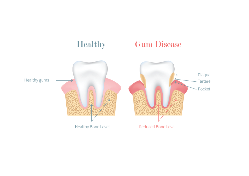 The Ultimate Guide to Maintaining Healthy Gums: Tips for a Strong Smile