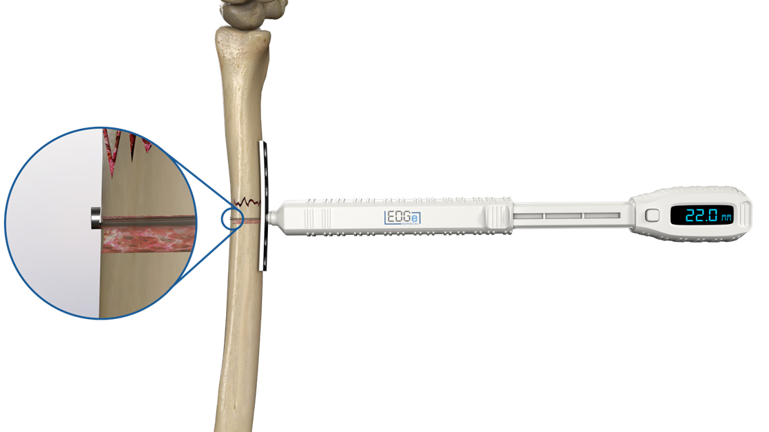 EDG Ortho Digital Depth Gauge Orthopaedic Spinal Foot Ankle Wrist Hip Trauma Arthrodesis New Zealand Australia