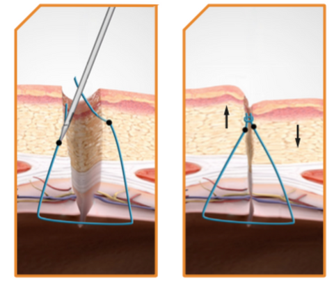 M-Close Kit Symmetrical Needles reduce dimpling