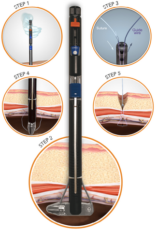 M-Close Kit how to use