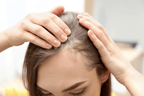 Alopecia hair loss