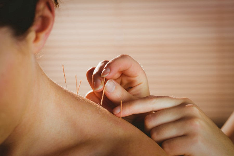 Acupuncture Treatment