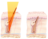 Laser Hair Removal vs. Intense Pulse Light (IPL) Diagram