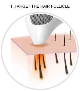 Illustration of Tria Beauty Hair Removal Laser 4X targeting the pigment in the hair follicle