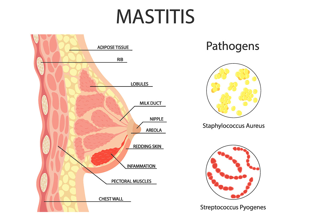 Mastitis