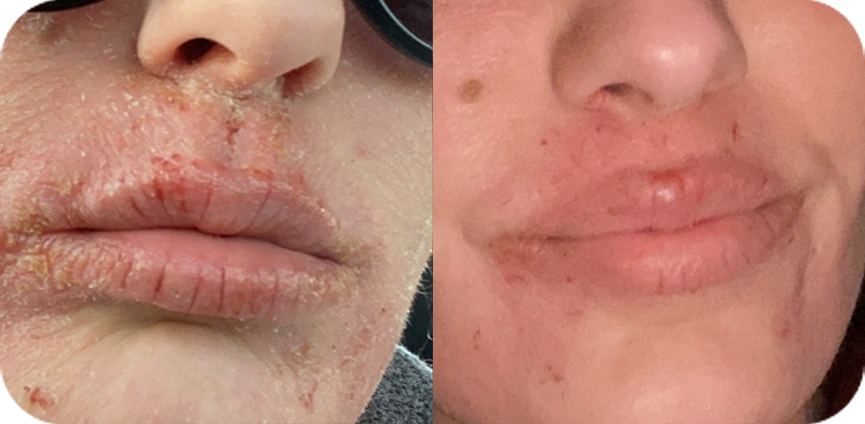 eczema flare-up on her face