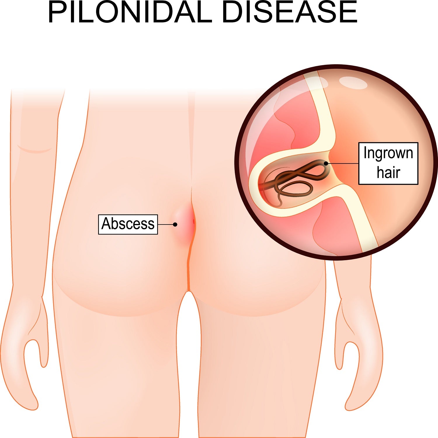 Pilonidal Cyst