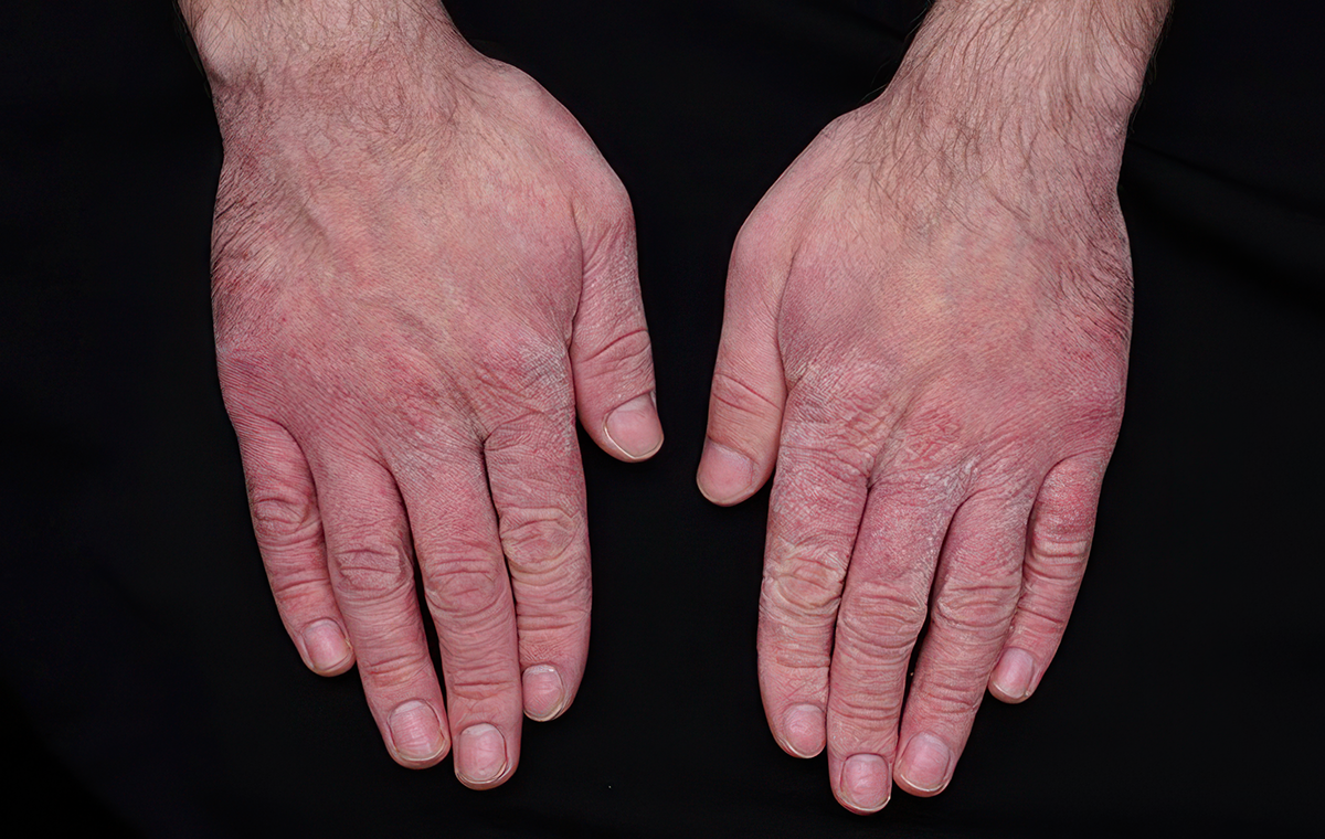 Eczema on hand