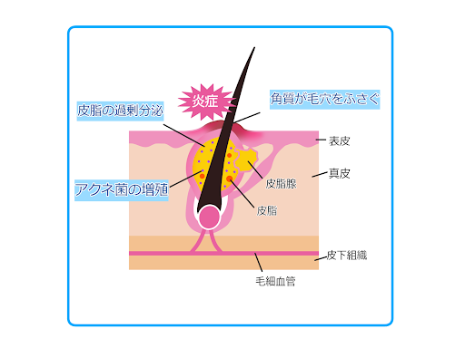 ニキビはどうやってできるの？