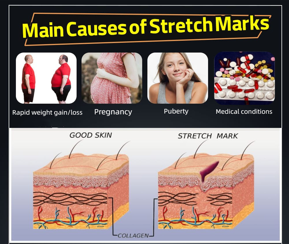 Stretch Marks Types