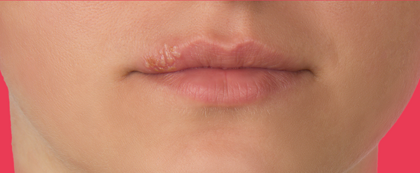 Stages Of A Cold Sore (Stage 5)