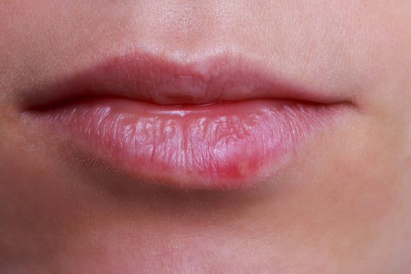 Stages Of A Cold Sore (Stage 3)