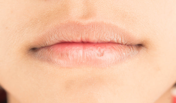 Stages Of A Cold Sore (Stage 8)