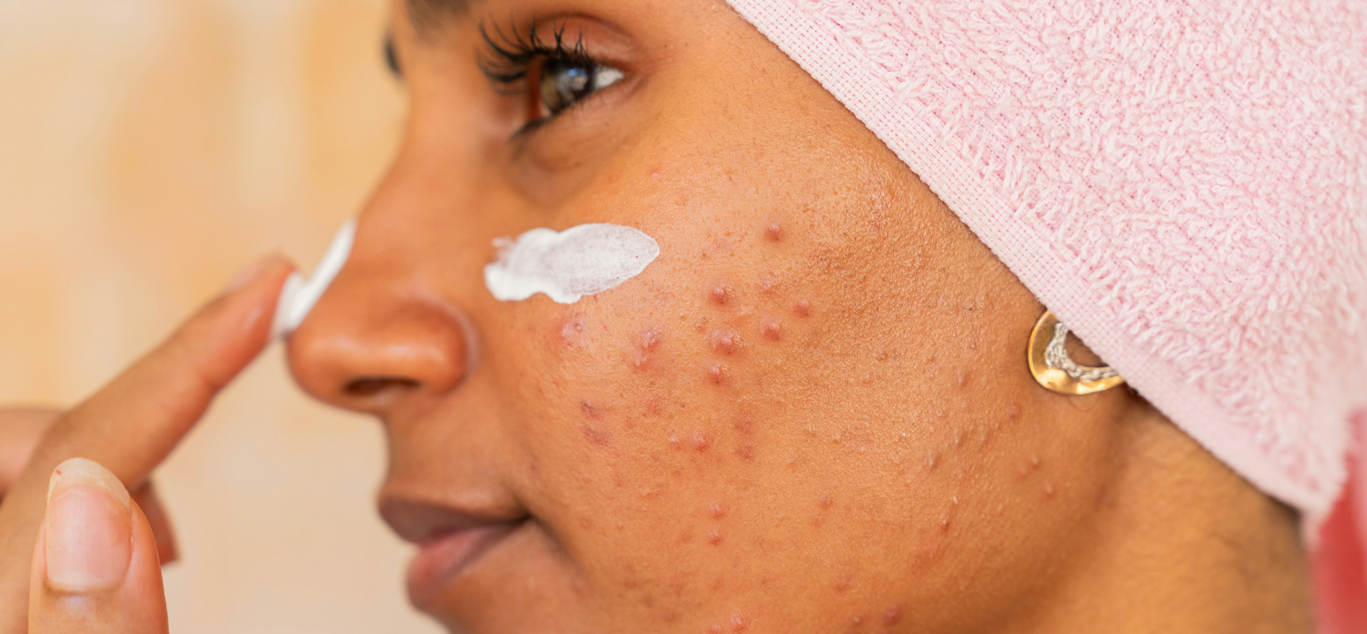 Woman with acne putting moisturiser on