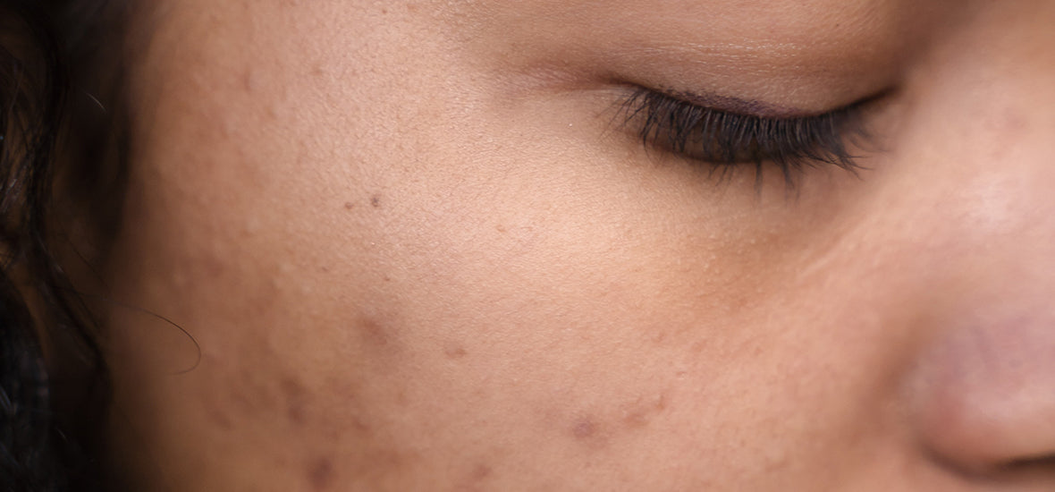 Woman looking sad with acne from stress.