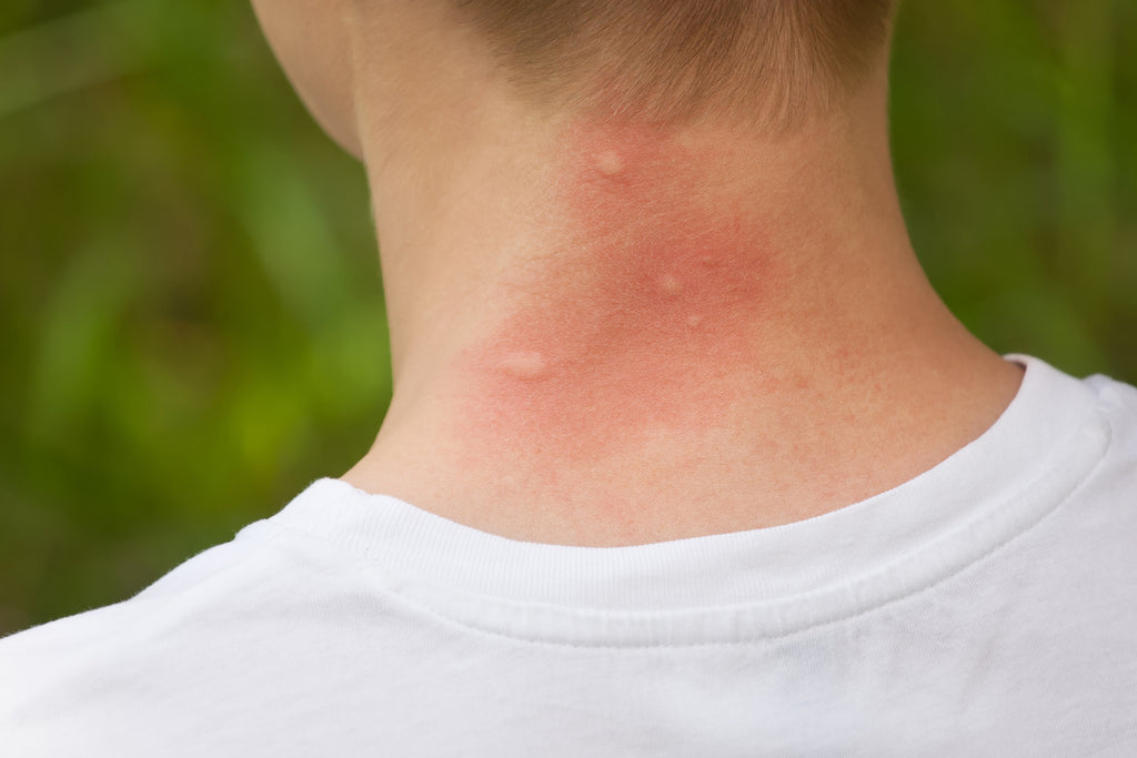 hvorfor klør myggestik undgå myg