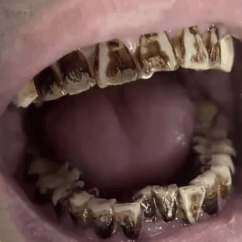 New PROPOLIS TeethRegrowth Dental Gel