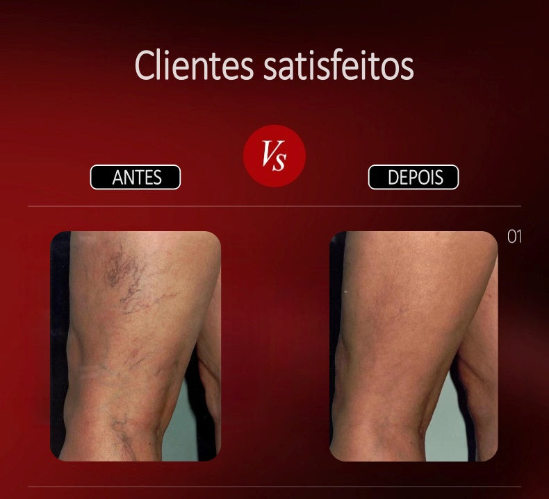 Ele foi desenvolvido por dermatologistas especialistas no tratamentos de varizes, vasos inchados, edemas e trombose, com o intuito de previnir e reduzir ao máximo as varizes e vasos inchados!