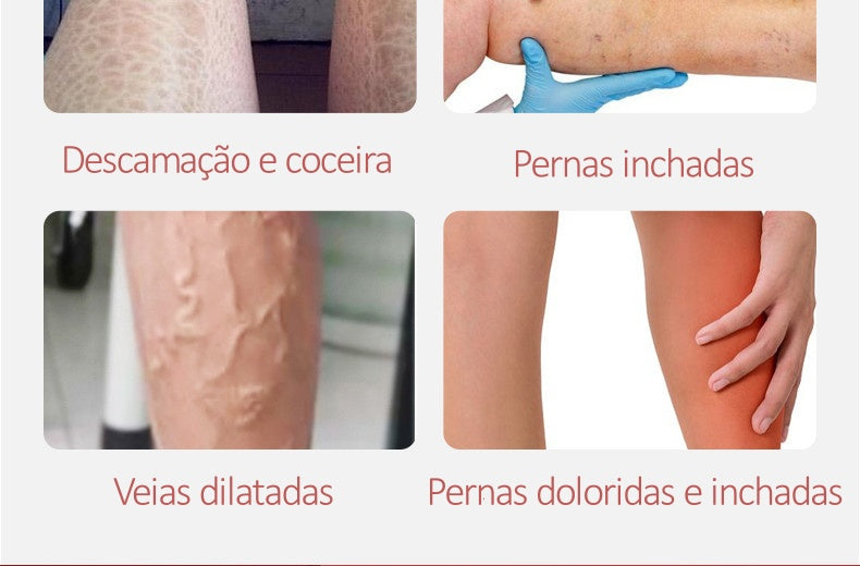 O QUE TORNA O VARICOSE VEINS TÃO EFICIENTE? Combina ingredientes naturais selecionados para renovar as células, enquanto melhora a circulação sanguínea, firma e hidrata a pele promovendo em cada aplicação a redução efetiva de varizes, alívio de dores e cansaço nas pernas. O pacote inclui: 1 unidades de creme para varizes Varicose Veins Validade: 2 anos