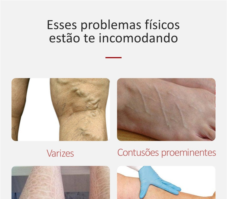 Conheça o Creme Removedor de Varizes Varicose Veins