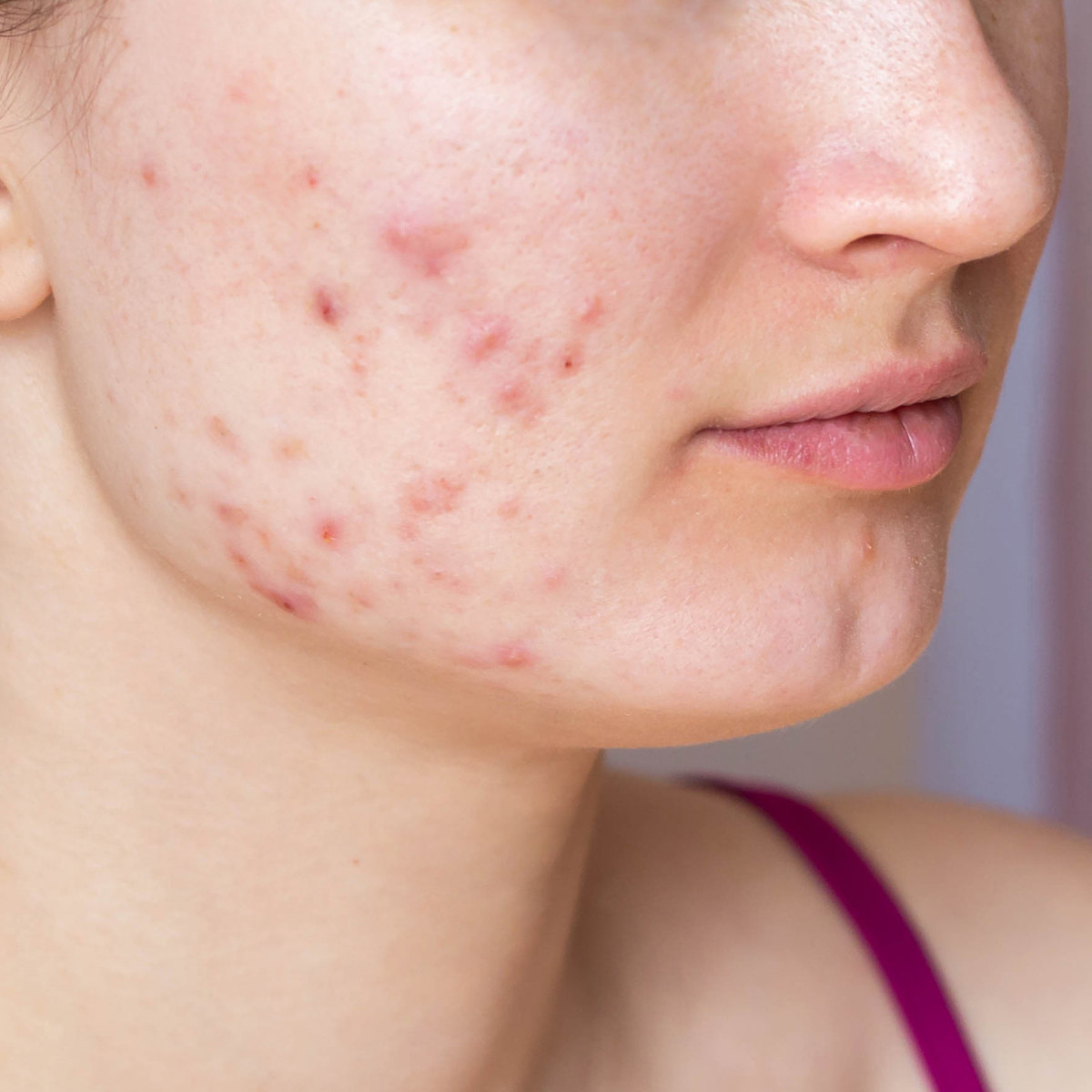 Acne before and after 