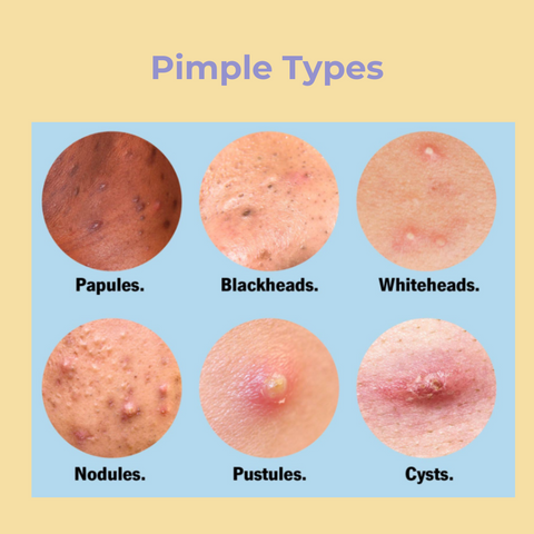 Types of pimples diagram