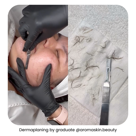 Woman’s face before and after dermaplaning by a graduate of IBI’s dermaplaning course online