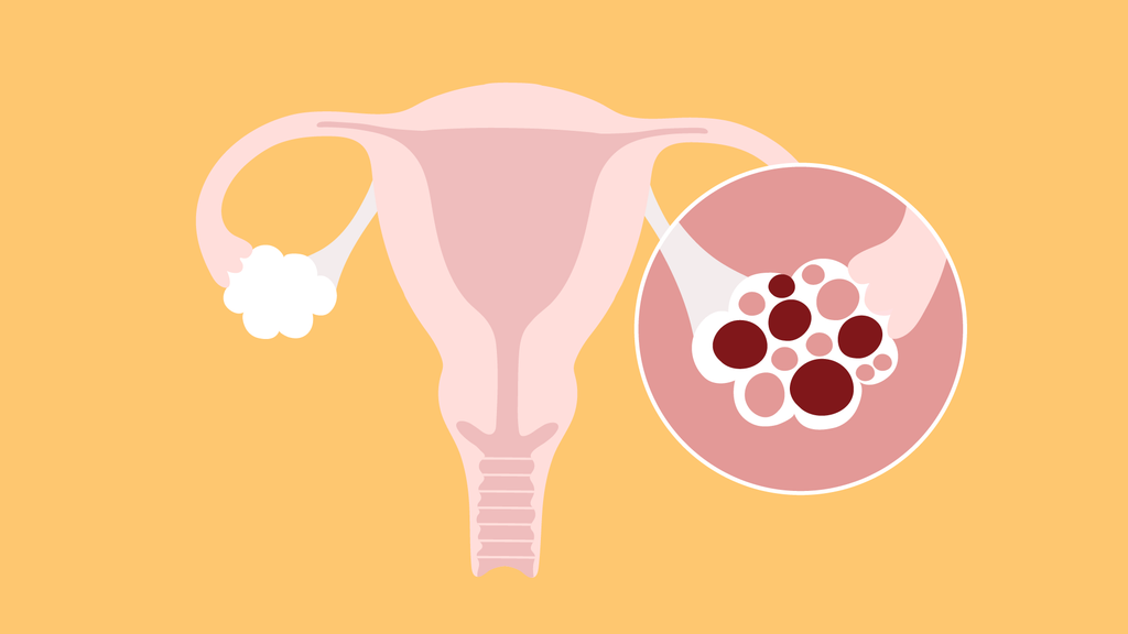 female reproductive system with polycystic ovary syndrome pcos