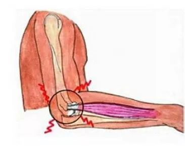 tennis elbow