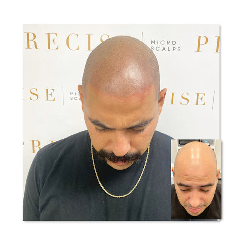 Scalp Micropigmentation  solutions for hair loss  DarkOct02