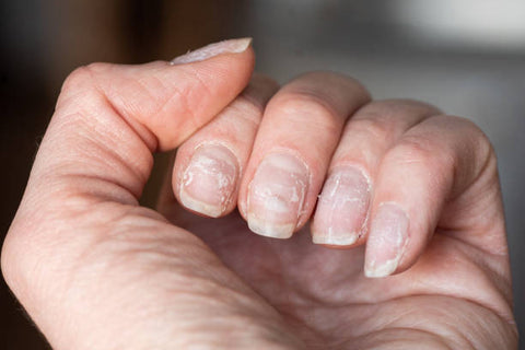 Can Acrylic nails cause Nail Fungi? | Elim Spa Products