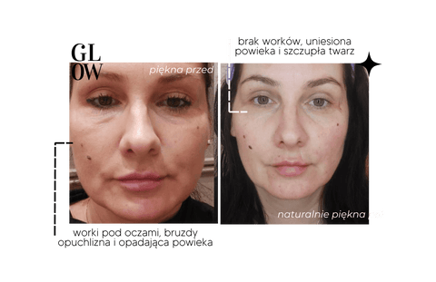 przed i po efekty masażu twarzy