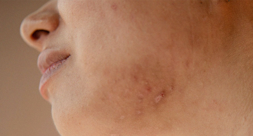 Detailed close-up of a woman's face showing clear, healthy skin texture.