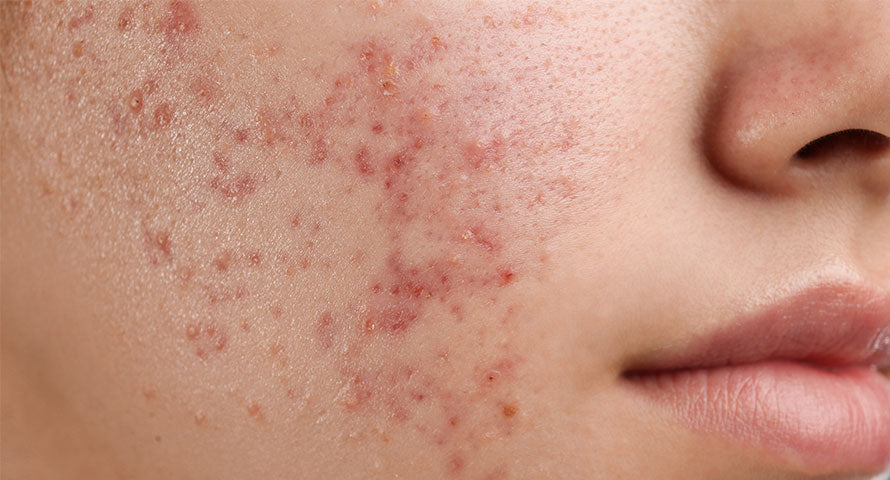 Close-up image of a woman's cheek displaying acne, focusing on the inflamed blemishes and skin texture, illustrating the visible effects of acne on the skin.