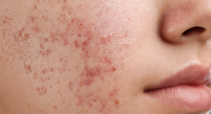 Close-up of a woman's face showing visible acne, highlighting skin condition.