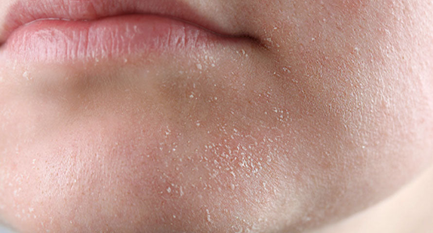 Close-up image of a woman's chin covered with visible white dead skin cells, illustrating skin exfoliation needs.