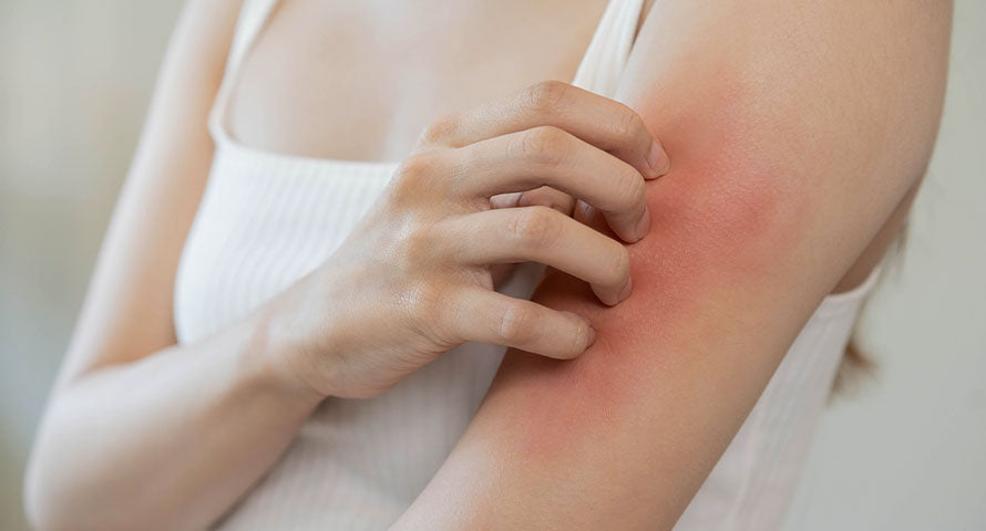 Close-up of a woman's arm showing redness indicative of an allergic reaction.