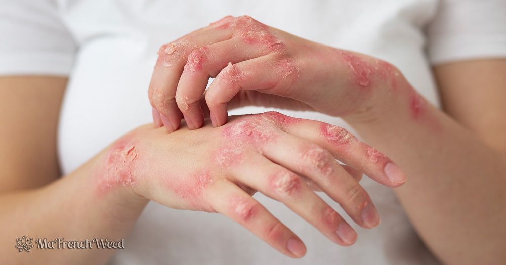 CBD PSORIASIS MAFRENCHWEED