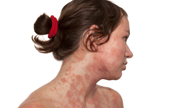 girl face and body skin infected with allergies