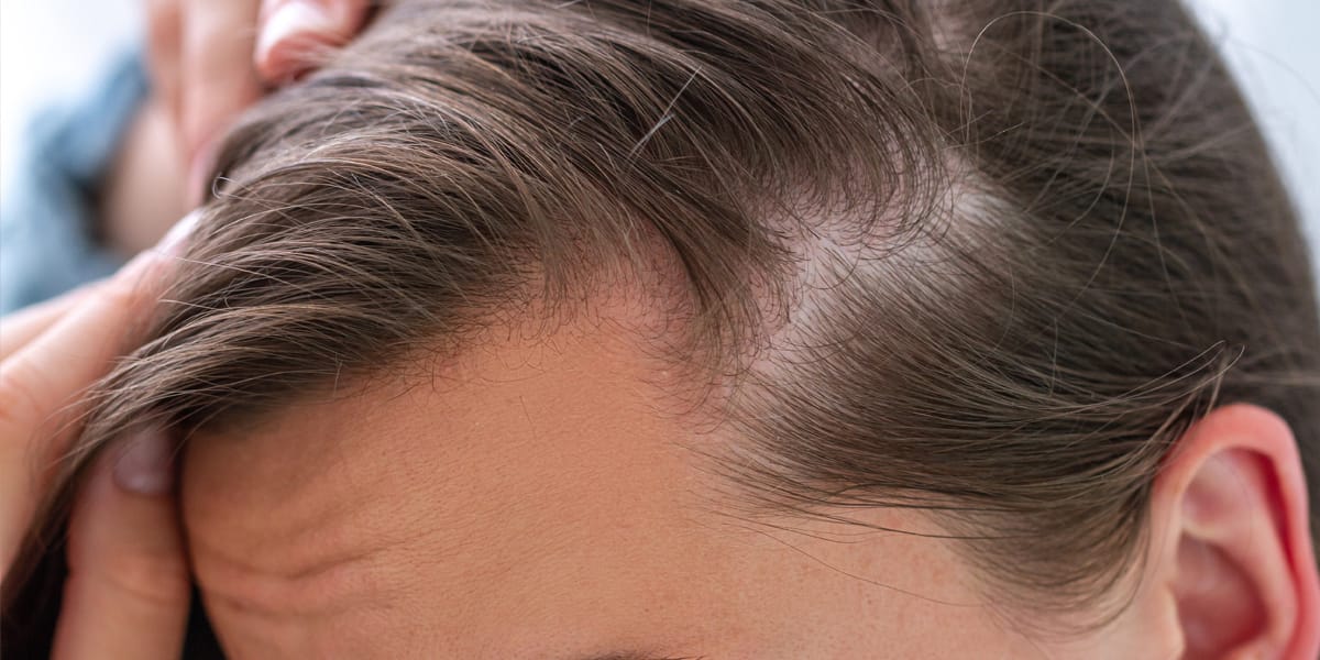 Lady suffering from Telogen Effluvium hair loss