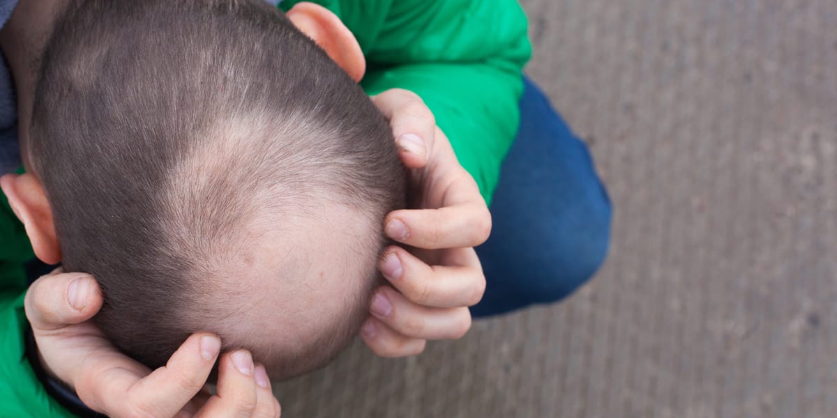 Man suffering from hair loss