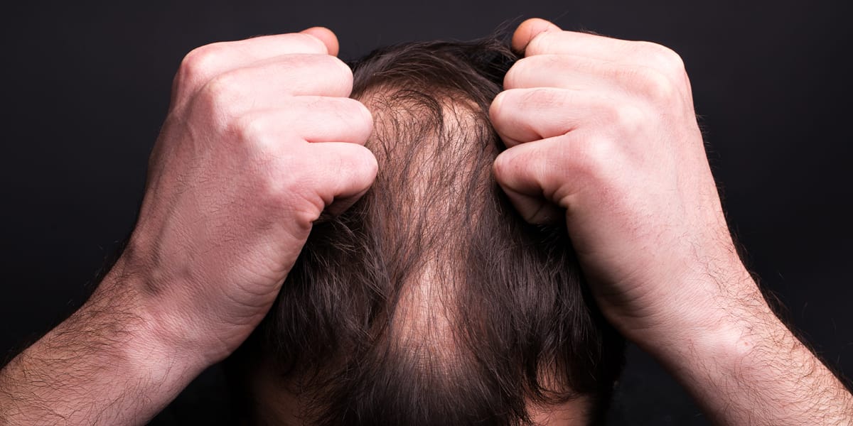 Man suffering from hair loss as a result of stress